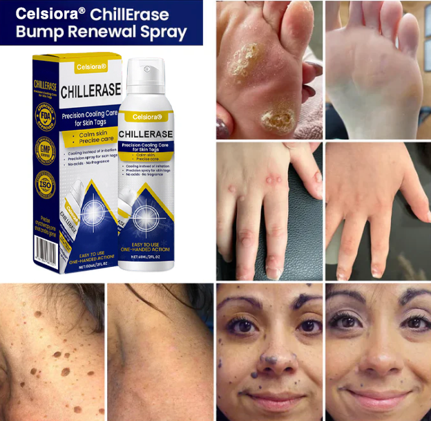 Celsiora® ChillErase Kühlspray für Hautanhängsel