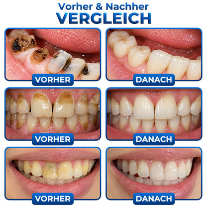 ⭐️Rolimey® BioFill – Natürliches Zahnschmelz-Füllgel zur Kariessanierung