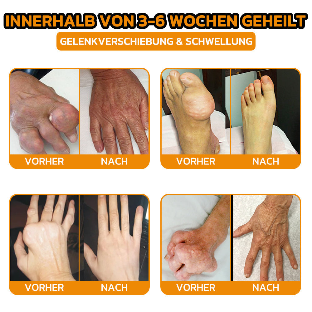 ✨flysmus® Bienengift Sofort-Ultra-Stärke Schmerztherapie-Creme🇩🇪