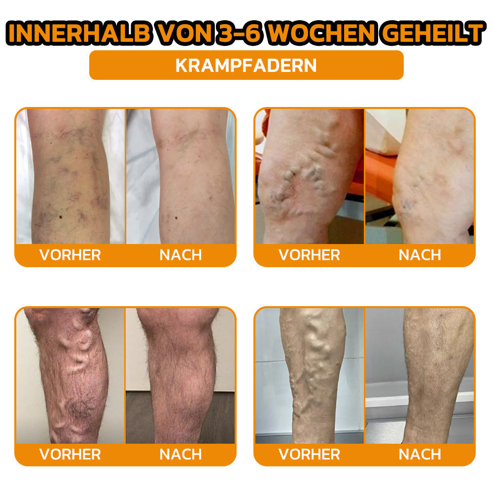 ✨flysmus® Bienengift Sofort-Ultra-Stärke Schmerztherapie-Creme🇩🇪