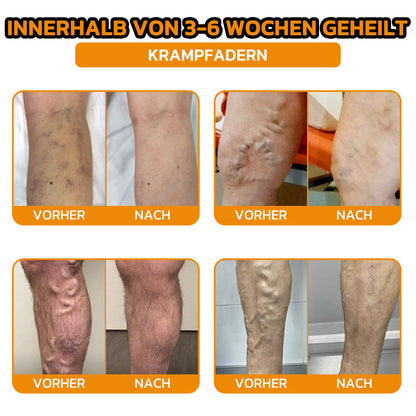 ✨flysmus® Bienengift Sofort-Ultra-Stärke Schmerztherapie-Creme🇩🇪