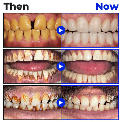 🤍🦷 Furzero® Focussmile Bienengiftbehandlung Pulver zum Einnehmen(🇩🇪 BZÄK Zugelassen)