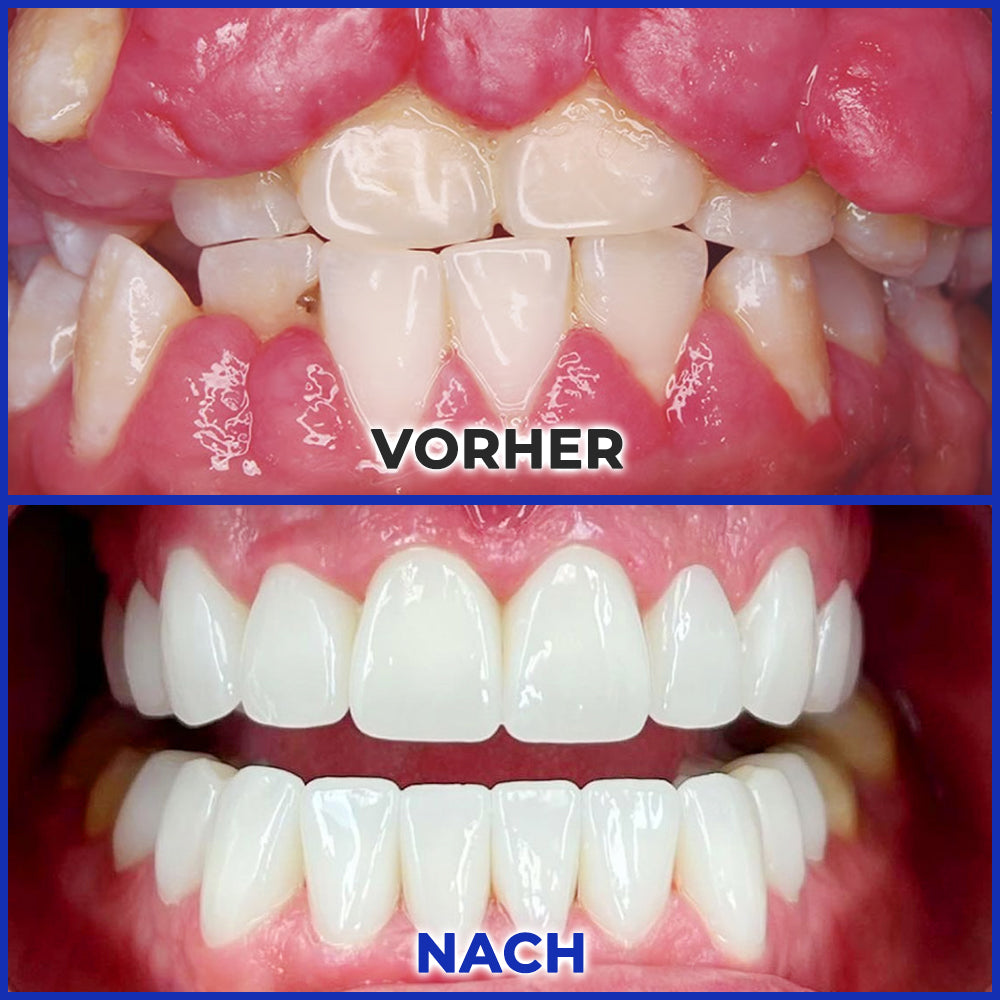 Rolimey® MicroSmile Zahnbehandlung mit Bienengift Ultrafeine Schaumzahnpasta mit Zungenschaber