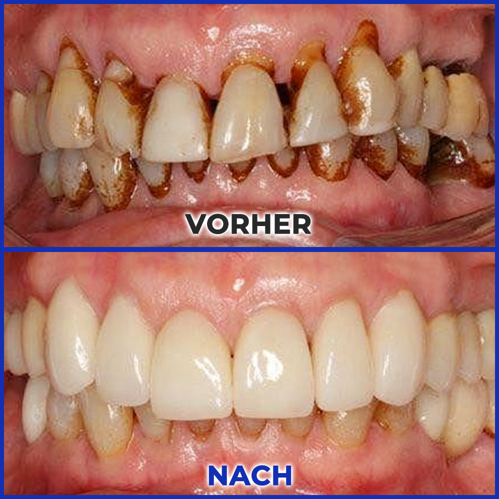 Rolimey® MicroSmile Zahnbehandlung mit Bienengift Ultrafeine Schaumzahnpasta mit Zungenschaber