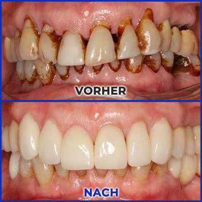 Rolimey® MicroSmile Zahnbehandlung mit Bienengift Ultrafeine Schaumzahnpasta mit Zungenschaber